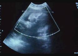 Unborn but Forgotten